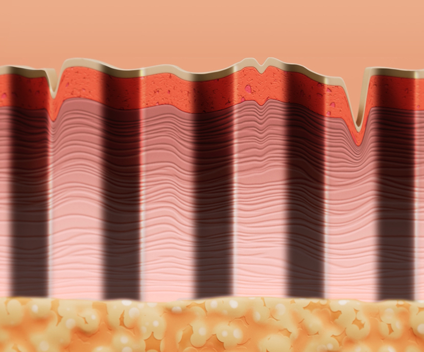 Ellacor procedure illustration showing micro-cores in skin.