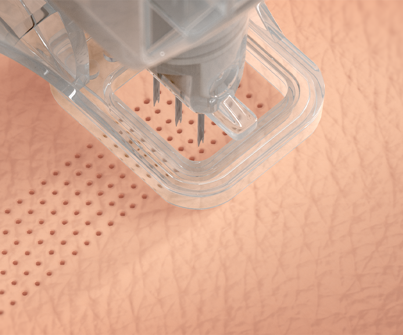 Illustration of the ellacor procedure removing micro-cores of skin.