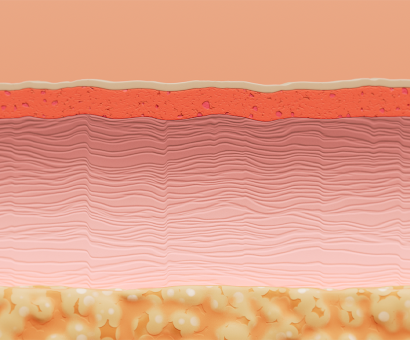 Ellacor procedure illustration showing tightening skin.