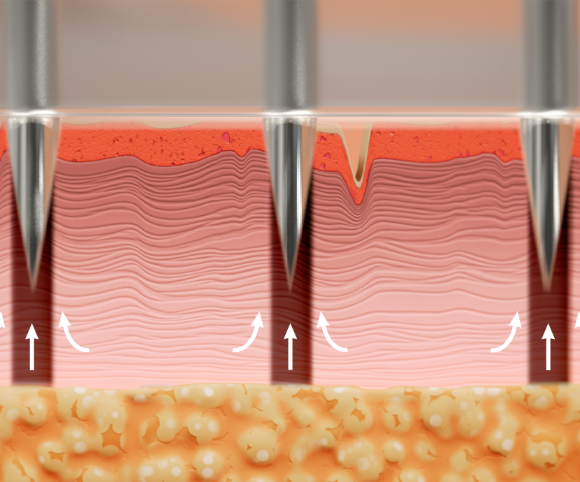 Ellacor Micro-coring technology showing needles in skin.