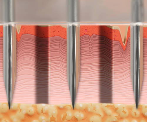 Ellacor procedure showing needles making micro-cores of skin.